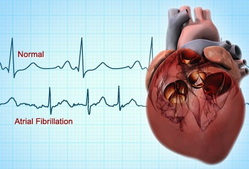 Flutterul atrial - cea mai periculoasă aritmie cardiacă